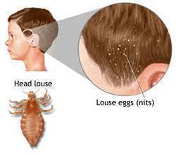 head_lice_content