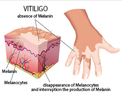 vitiligo1